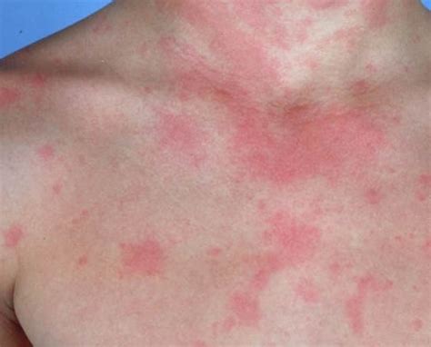 Heat Rash Versus Hives