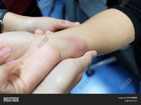 Broken Finger Bruise Spreading at Anthony Bohnsack blog