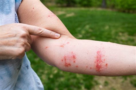 Poison Ivy | Dermatology Central Iowa