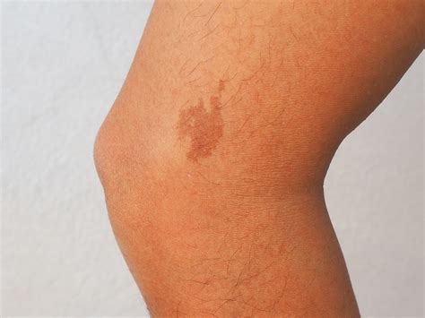 Birthmarks and the celebrities who embrace theirs