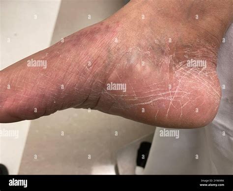 Moccasin type athlete's foot. Athlete's foot, or tinea pedis, is a form ...