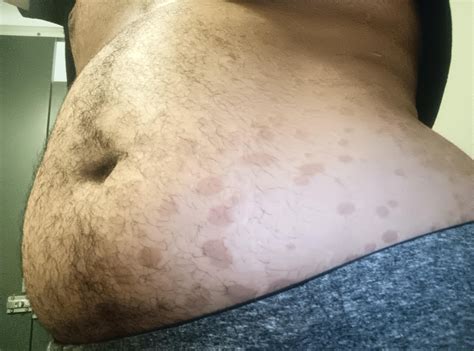 Red spots all over my chest stomach and back and it's itchy : r/DermatologyQuestions