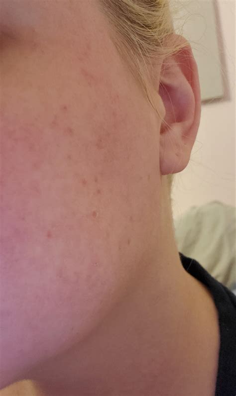 Ruddy Skin Complexion