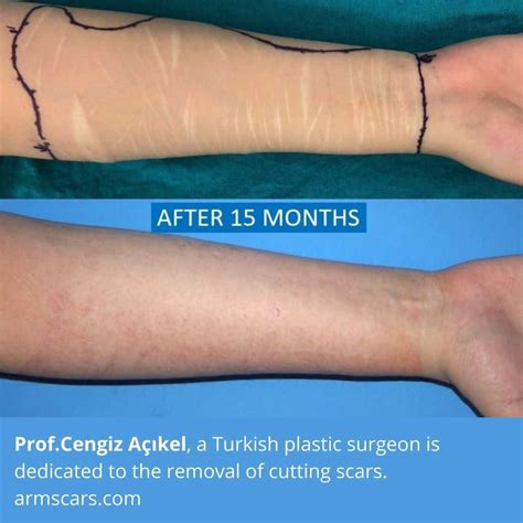 Why Do I Want My Cuts To Scar at Raymond Reed blog