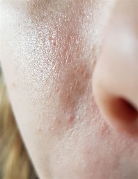 Clogged Pores Bumps