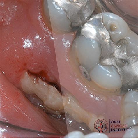 Osteoradionecrosis | Oral Cancer Institute