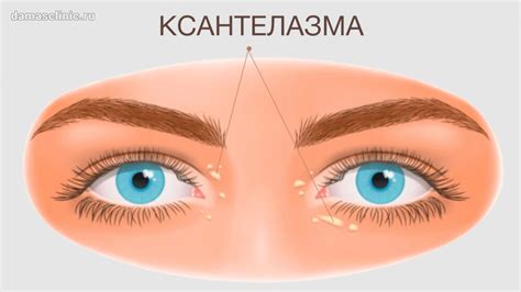 Удаление ксантелазм на веках в Москве - Damas Medical Center