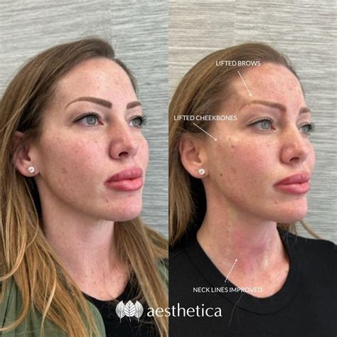 Pdo Thread Lift Before After Photos Parfaire Medical - vrogue.co