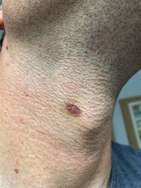 Mystery bruise on neck? 33/m/Louisiana. Spider bite? Ingrown hair ...