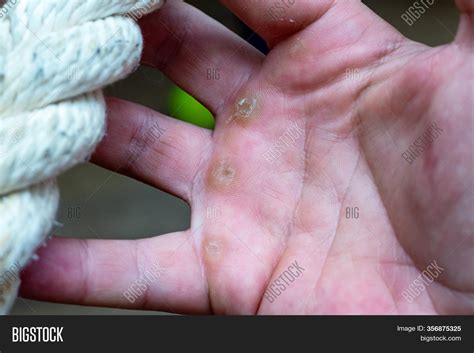 Calluses On Hand