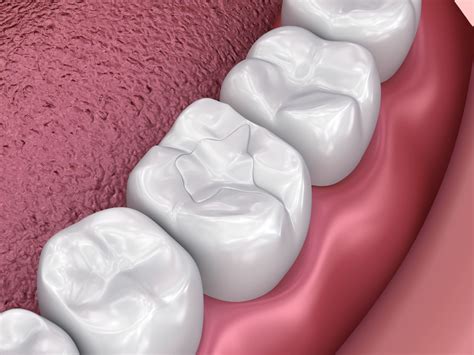 Tooth Colored Fillings