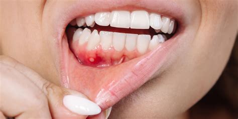 Mouth Cancer Bumps On Gums