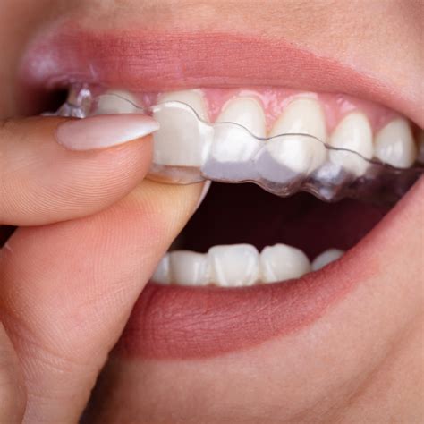 Invisalign aligners are the clear alternative to metal braces for adults and teens. These clear ...