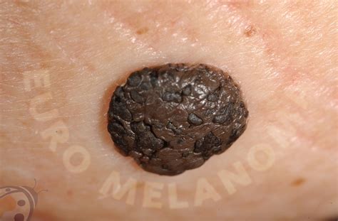 Seborrheic keratosis - Euromelanoma