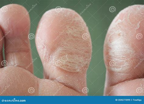 Skin Condition on Fingers Reveals Dryness and Rough Texture Stock Image - Image of anatomy ...