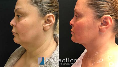 Laser Lipo For Double Chin at Donna Bull blog