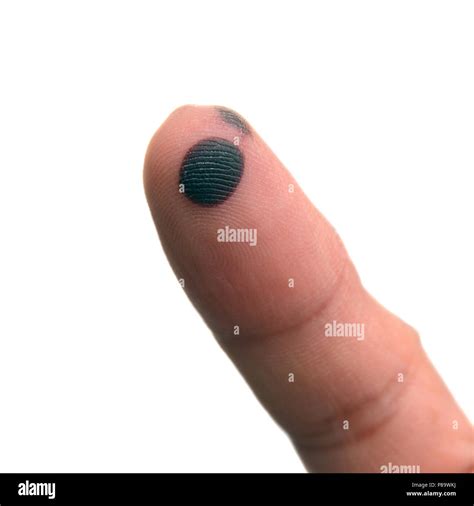a small bruise on the finger Stock Photo - Alamy