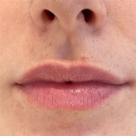 How Do Lip Fillers Dissolve at Max Renwick blog