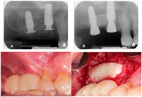 Utilization of Tenting Pole Abutments for the Reconstruction of ...