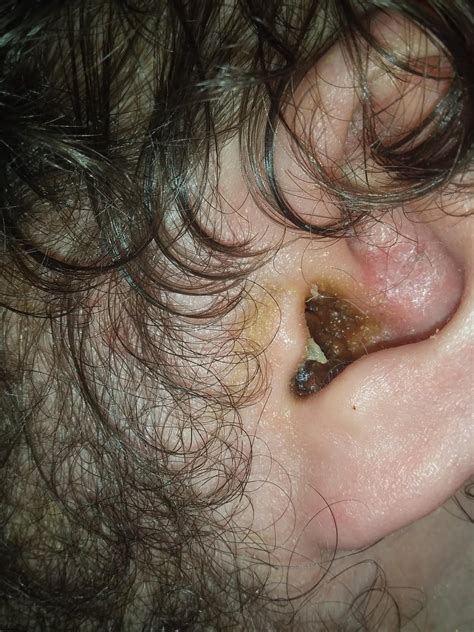 I know I got lots of earwax but my question is what is white part is ...