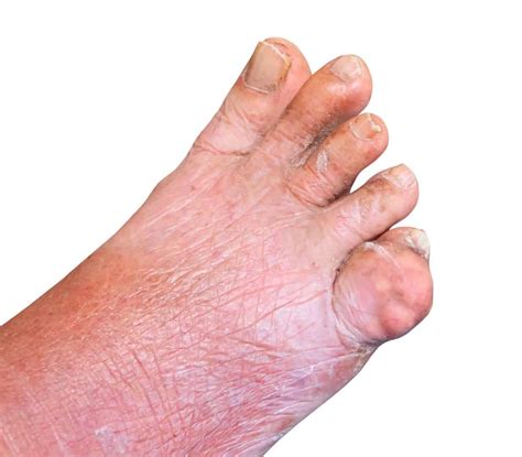 Gout In The Ankle