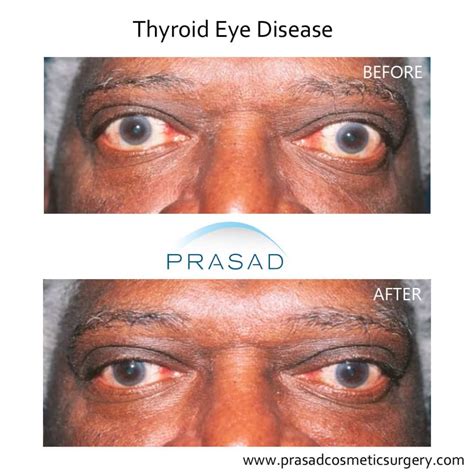 Hypothyroidism Before And After Photos Of The Eye All About Thyroid
