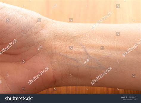 1,292 imágenes de Blue veins on arm - Imágenes, fotos y vectores de stock | Shutterstock
