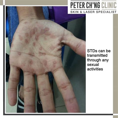 5 Most Common Misconceptions and Excuses of STDs | Peter Ch'ng Skin Specialist - KL, Malaysia