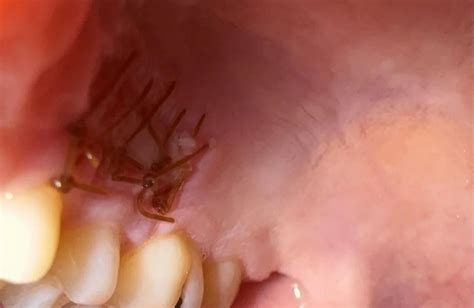 Dissolvable Stitches Hanging in Mouth | Medico Sutures