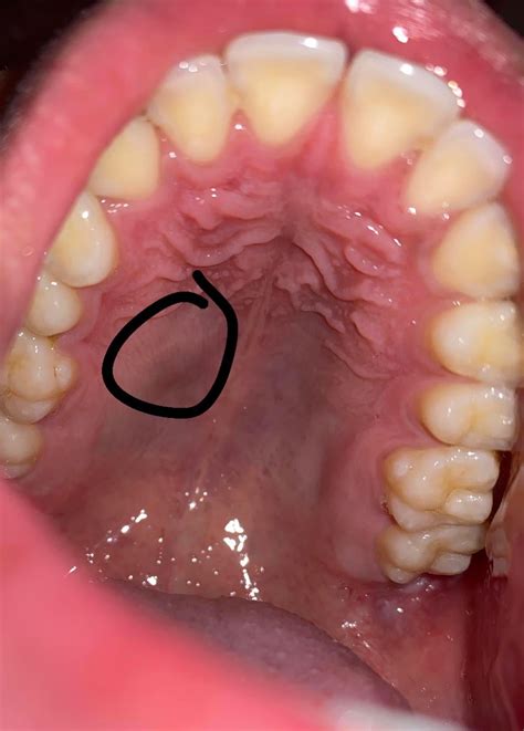 I have this swollen part on top roof of my mouth. It really doesnt hurt ...