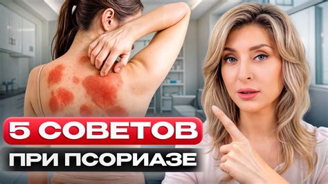 Как БЕЗОПАСНО и НАВСЕГДА избавиться от псориаза? / Самые эффективные ...