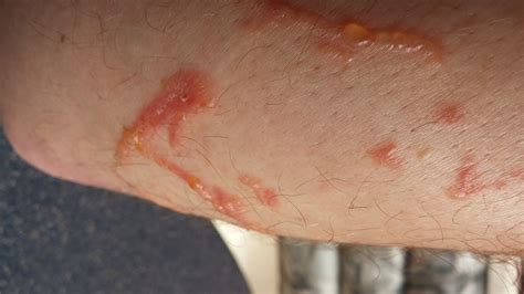 Poison Ivy Rash Stages at Zoe Bastyan blog