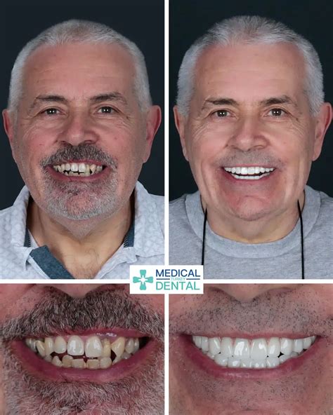 Screw or Screwless Dental Implants - Medical Dental Turkey