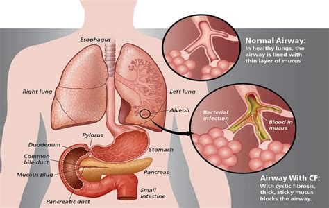 CYSTIC FIBROSIS - TYPES CAUSES AND FUNCTIONAL CLASSES OF CFTR GENE ...
