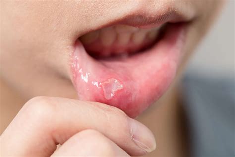 Canker Sore On The Gums