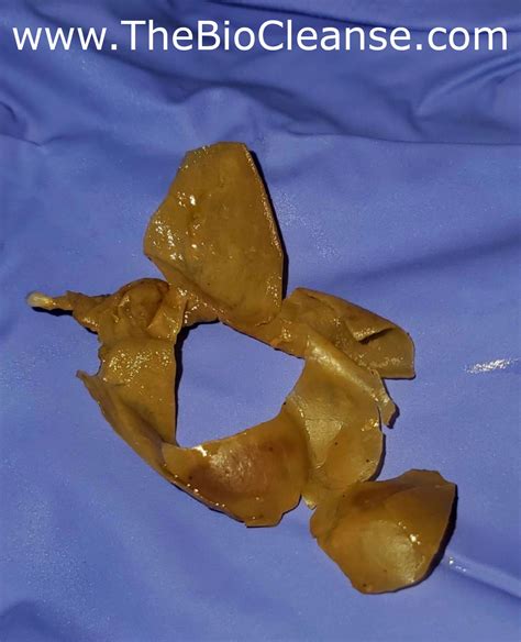 Mucoid Plaque Photos