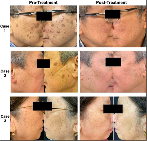 Successful use of picosecond laser treatment for seborrheic keratosis in three Asian patients ...