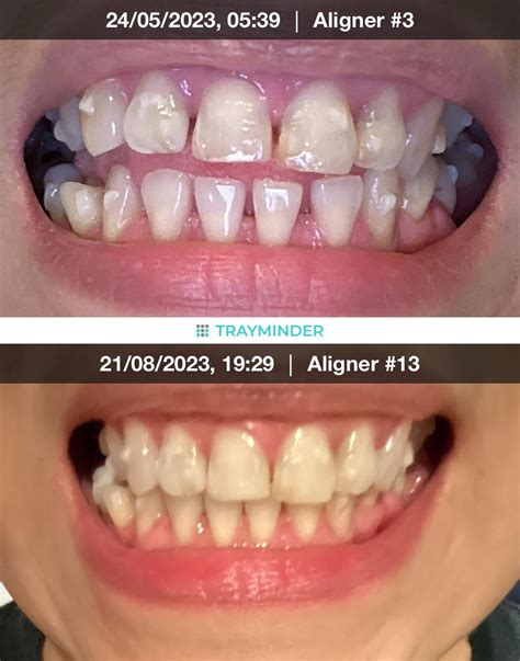 16 out of 24 trays in. Dying front tooth but good progress. Still glad ...
