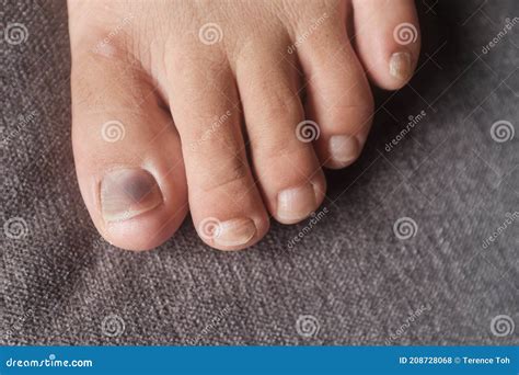 Injure Toenail Royalty-Free Stock Photography | CartoonDealer.com #25985993
