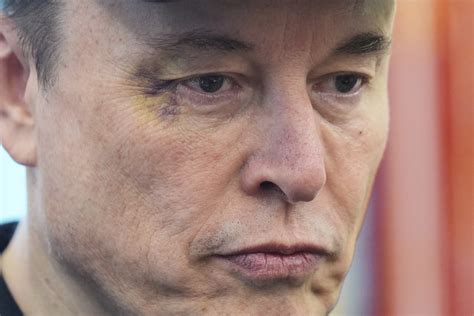 Why does Elon Musk have a black eye? | News