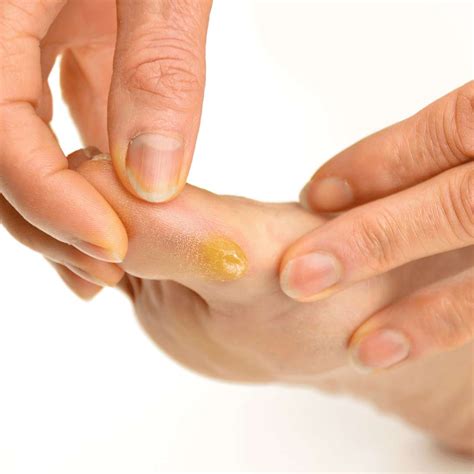 Corn And Callus Causes at Thomas Kidwell blog