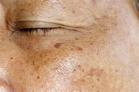 Hyperpigmentation Face