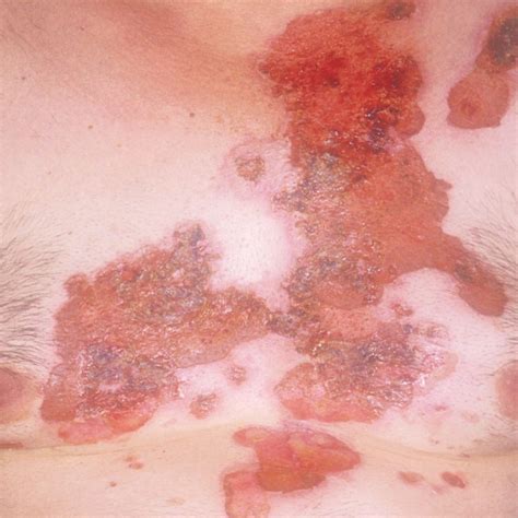 PEMPHIGUS - Best Skin Clinic in Gurgaon