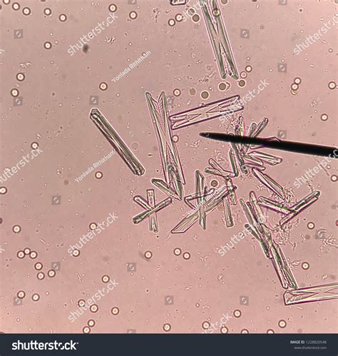 Triple Phosphate Crystals In Urine