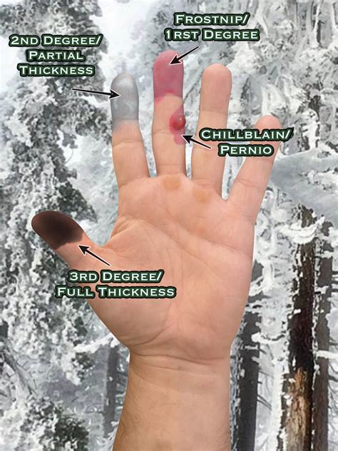 Frostnip