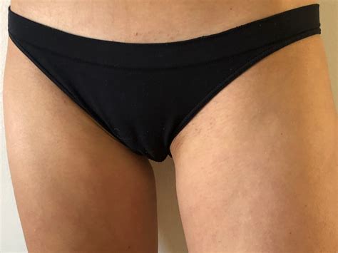 Ingrown Pubic Hair Male