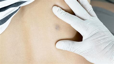 Watch Dr. Pimple Popper "Pop" a Giant Mass from a Woman's Back | Allure