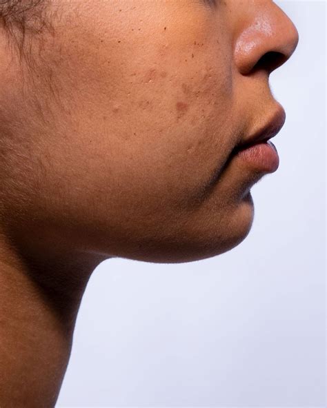 Hyperpigmentation post-inflammatoire : de quoi s'agit-il?