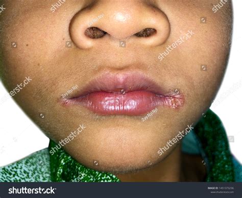 Angular Stomatitis Vs Cold Sore