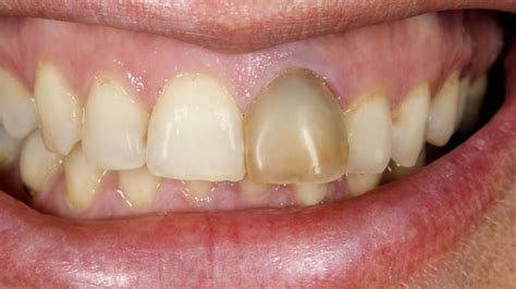 Black Marks On Teeth